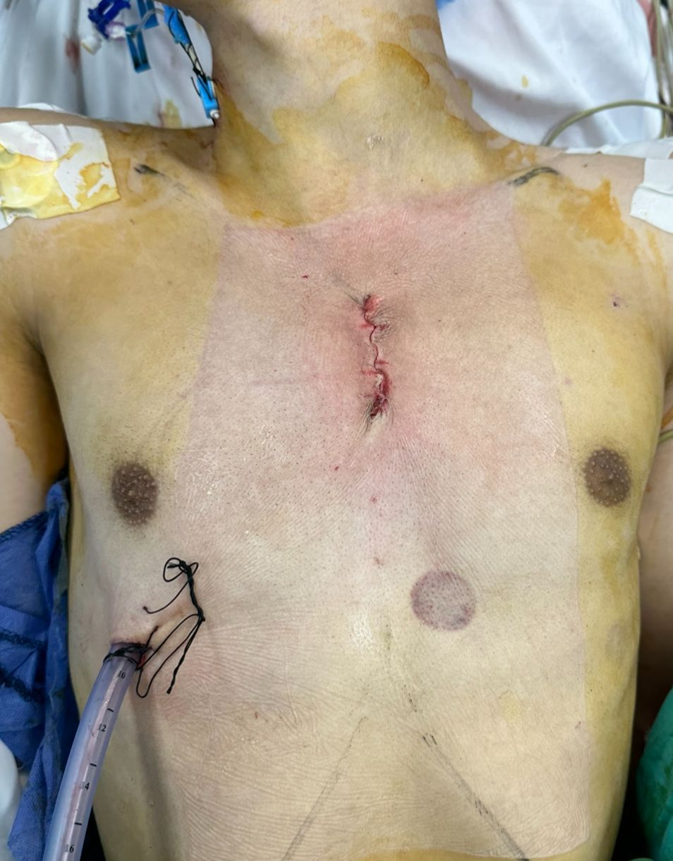 شكل جرح تغيير الصمام الأورطي بالتدخل المحدود