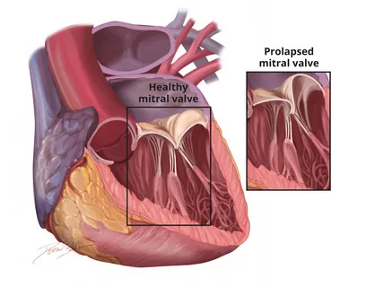 إرتخاء الصمام الميترالي